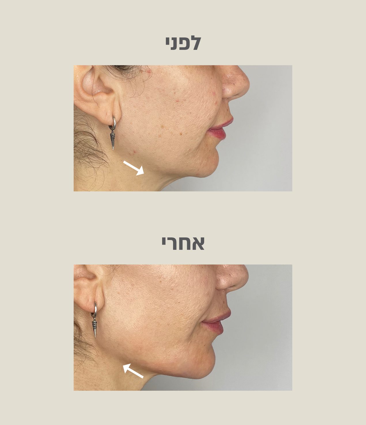 טיפול פיסול פנים לפני ואחרי