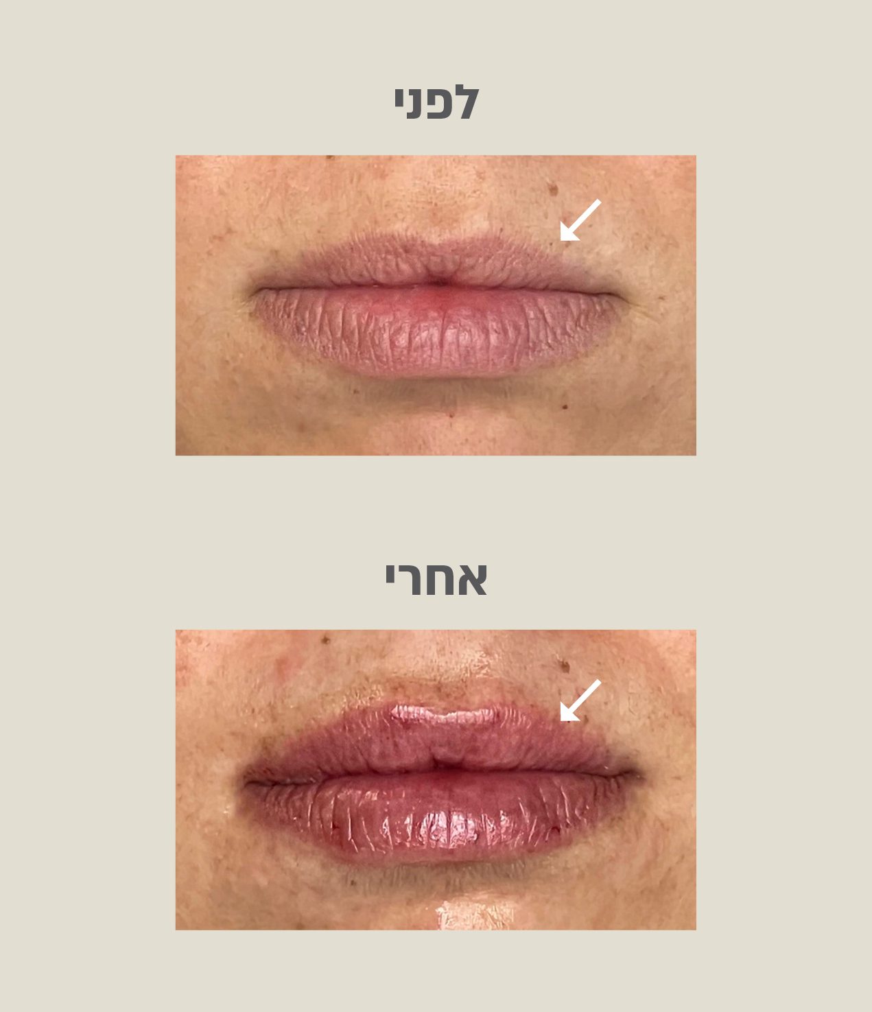 עיצוב שפתיים לפני ואחרי