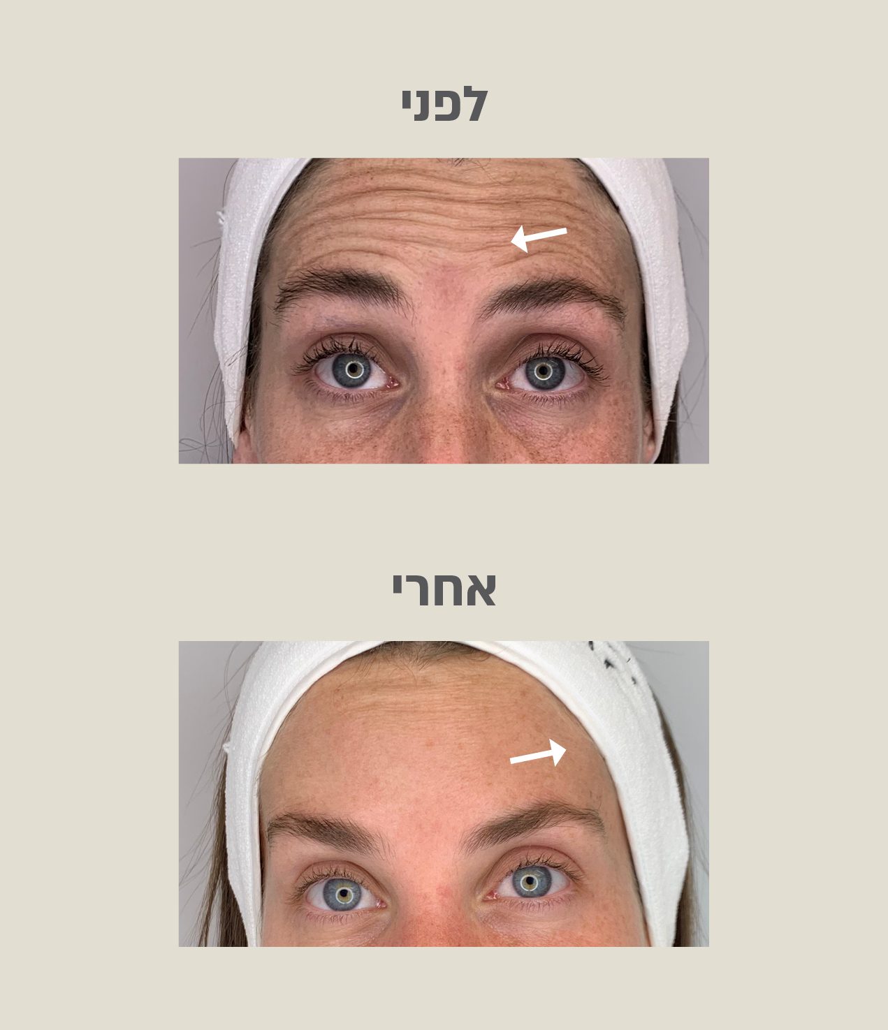 לפני ואחרי טיפול בקמטי הבעה
