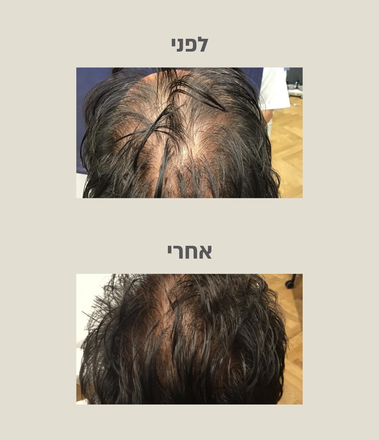לפני ואחרי טיפול PRP לעיבוי השיער