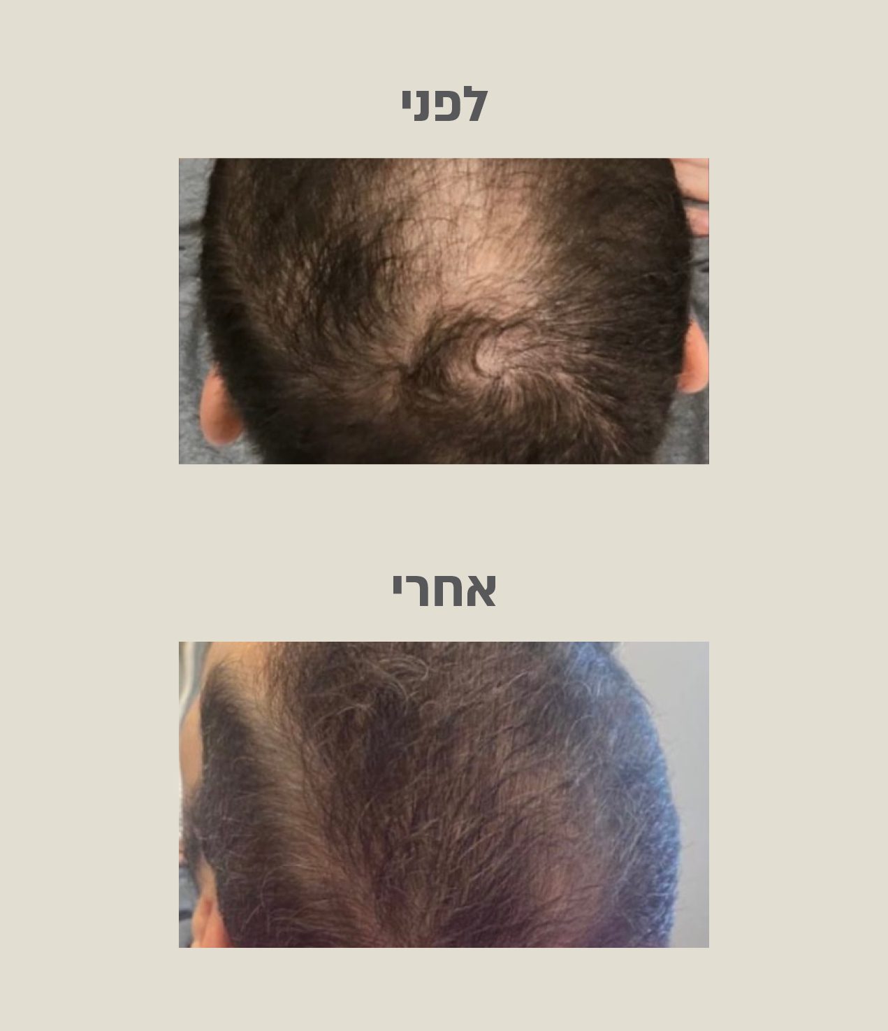 לפני ואחרי טיפול PRP לעיבוי השיער