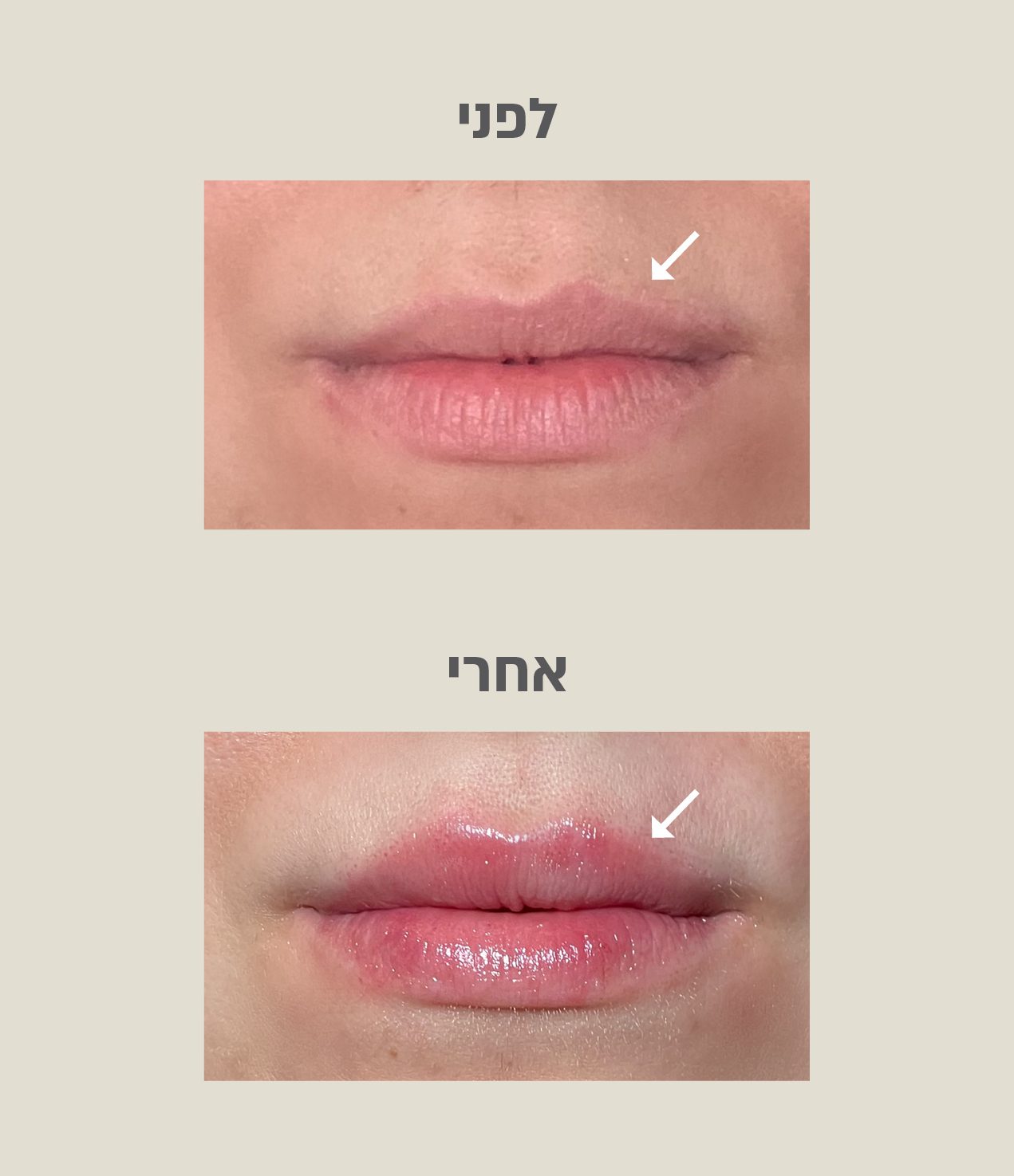 עיצוב שפתיים לפני ואחרי