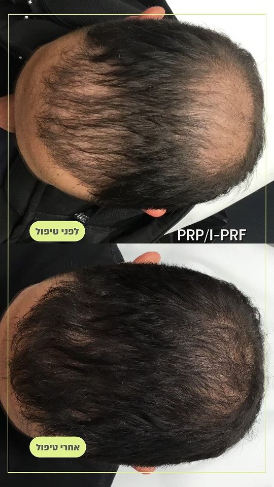טיפול PRP תמונות לפני ואחרי