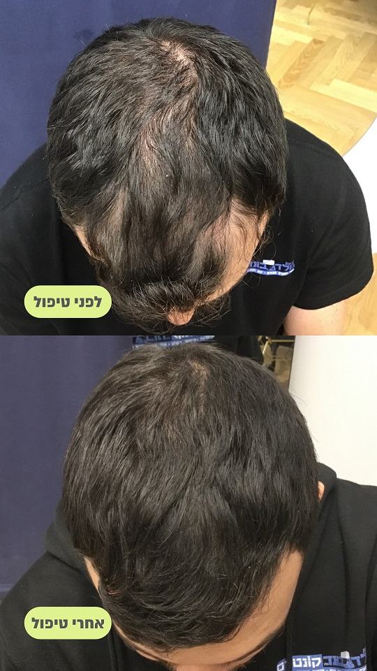 טיפול prp לשיער