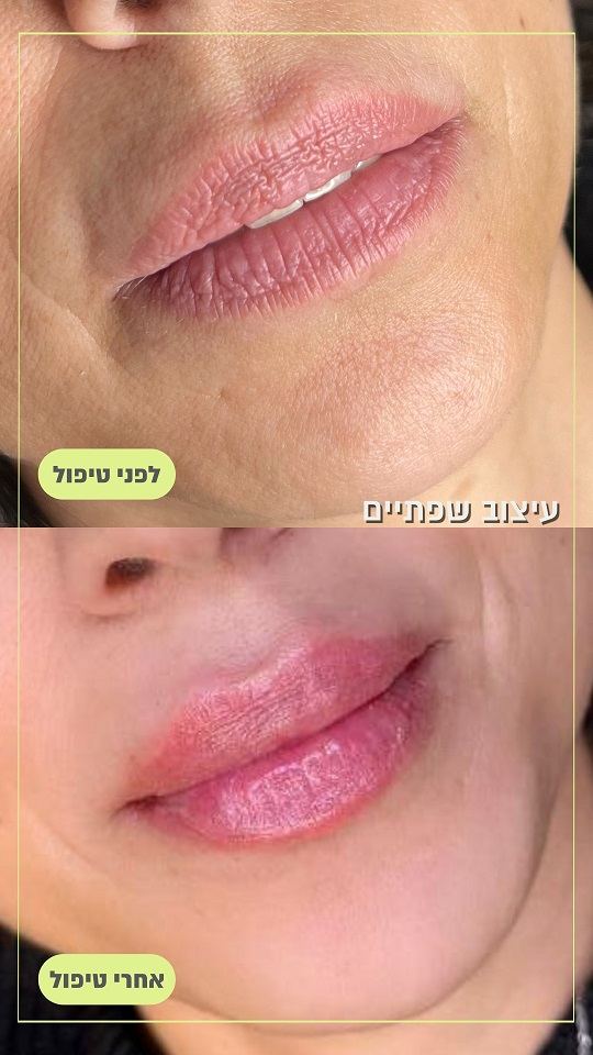 עיצוב שפתיים תמונות לפני ואחרי