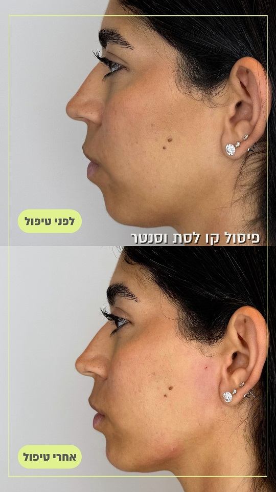 פיסול אף תמונה לפני ואחרי