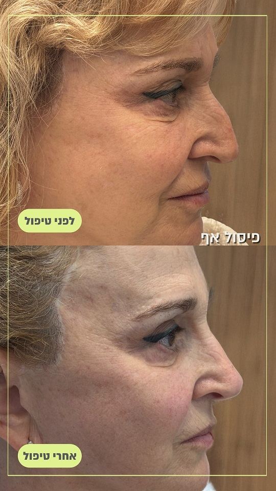 פיסול אף תמונות לפני ואחרי