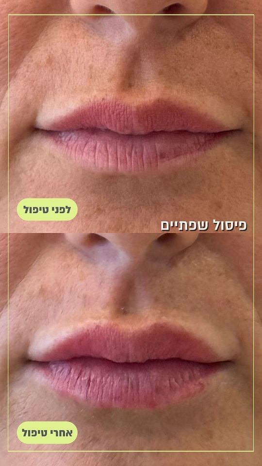 פיסול שפתיים תמונה לפני ואחרי