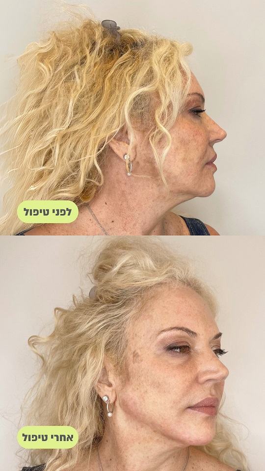 קו לסת תמונות לפני ואחרי