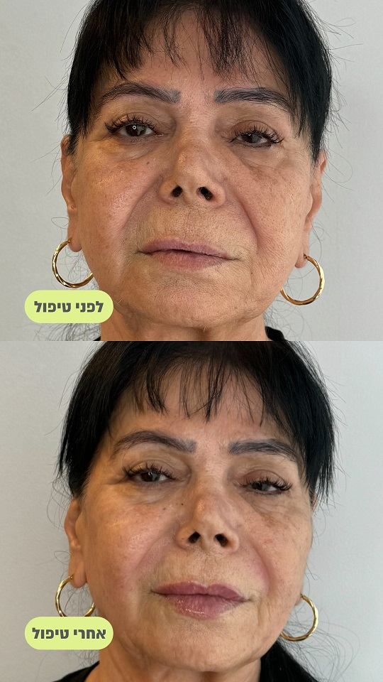 תמונות עיצוב שפתיים לפני ואחרי
