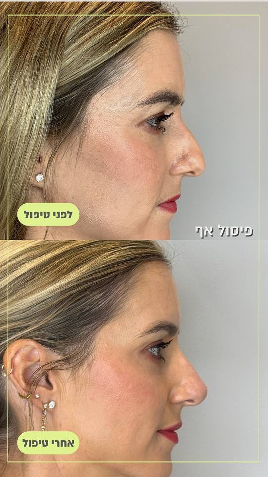 תמונות פיסול אף לפני ואחרי