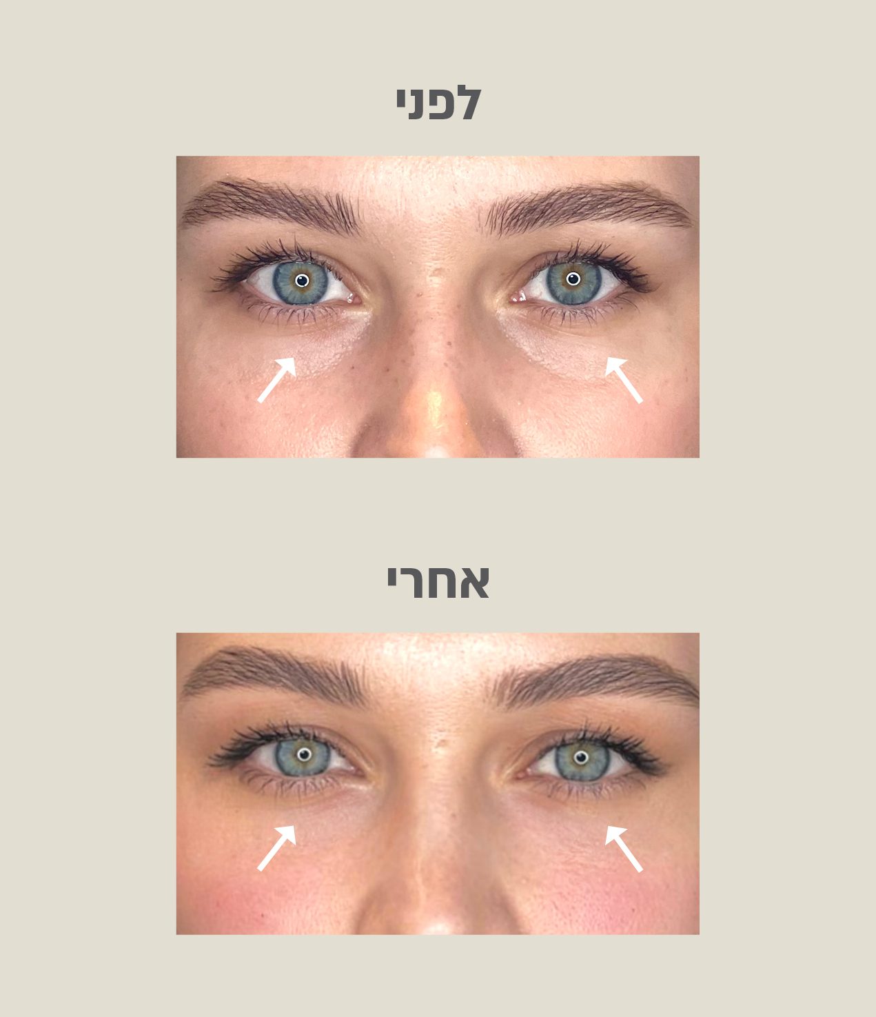 טיפול בשקעי עיניים לפני ואחרי
