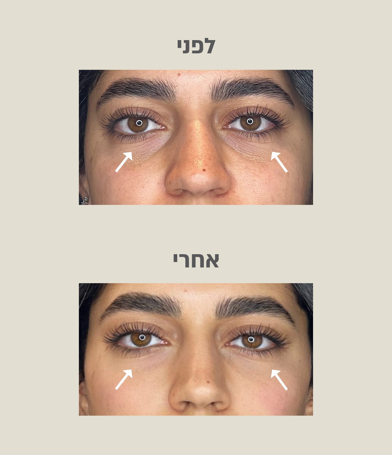 טיפול בשקעי עיניים לפני ואחרי