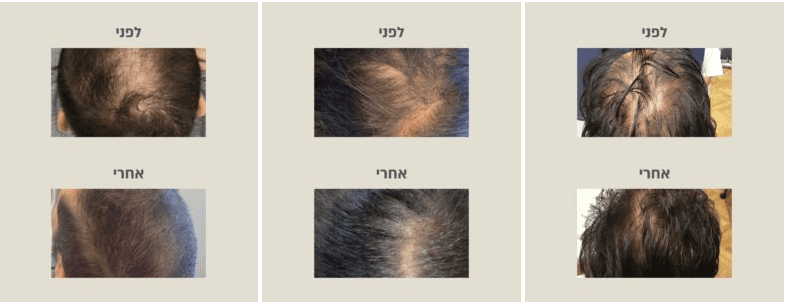 PRP לעיבוי השיער, לפני ואחרי